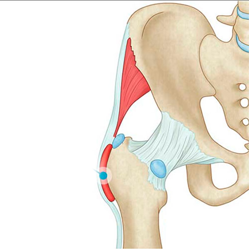 Bursitis trocantérica