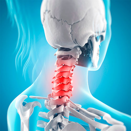 Cervicalgia