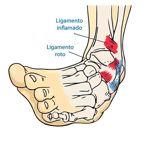 Esguince de tobillo