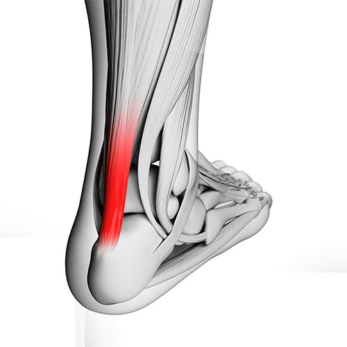 Tendinitis de Aquiles